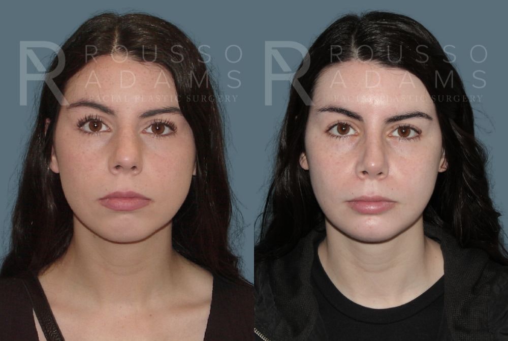 Rhinoplasty Before & After Gallery - Patient 147105361 - Image 2