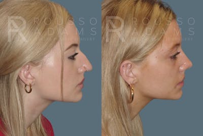 Rhinoplasty Before & After Gallery - Patient 148313254 - Image 1
