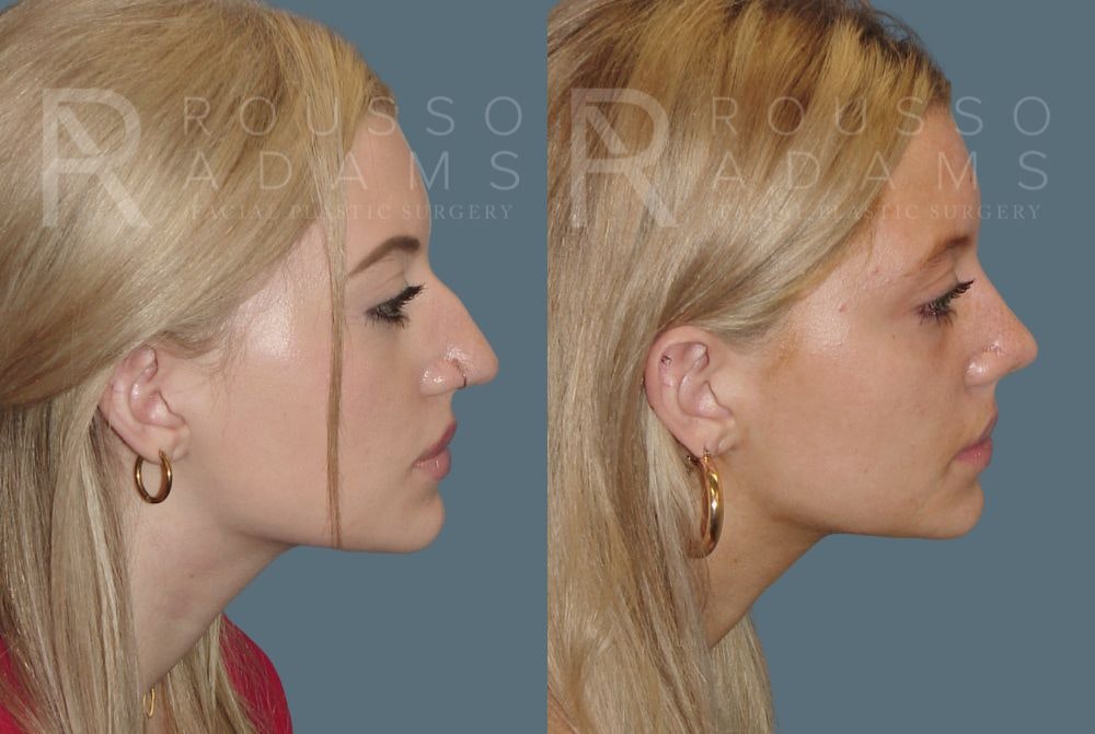Rhinoplasty Before & After Gallery - Patient 148313254 - Image 1