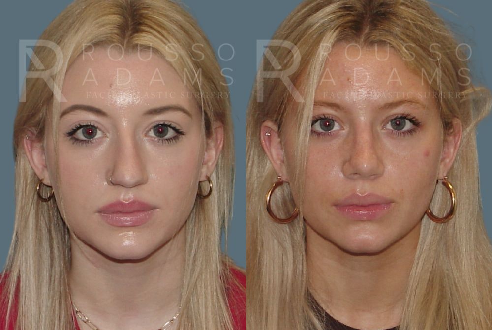 Rhinoplasty Before & After Gallery - Patient 147105363 - Image 2