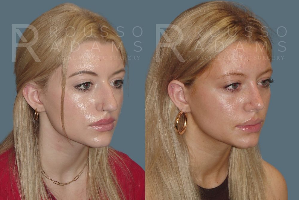 Rhinoplasty Before & After Gallery - Patient 148313254 - Image 3