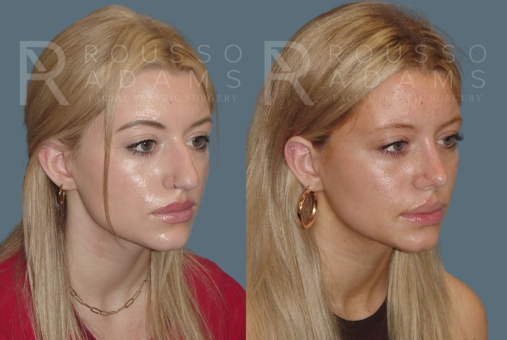 Rhinoplasty<span class=small>By Dr. Austin Adams</span> Before & After Gallery - Patient 148313254 - Image 3