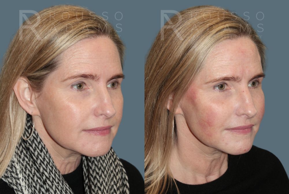 Liquid Rhinoplasty Before & After Gallery - Patient 147105366 - Image 2