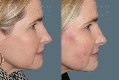 Liquid Rhinoplasty Before & After Gallery - Patient 147105366 - Image 1