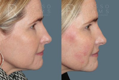 Liquid Rhinoplasty Gallery Before & After Gallery - Patient 147105366 - Image 1