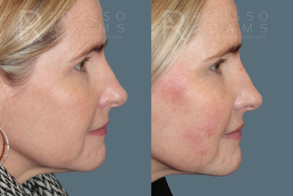 Liquid Rhinoplasty Gallery Before & After Gallery - Patient 147105366 - Image 1