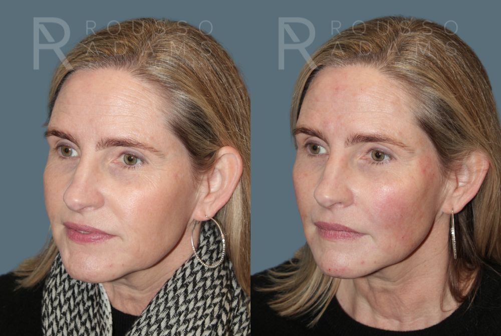Liquid Rhinoplasty Gallery Before & After Gallery - Patient 147105366 - Image 3