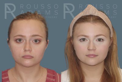 Hairline Advancement Before & After Gallery - Patient 190932 - Image 1