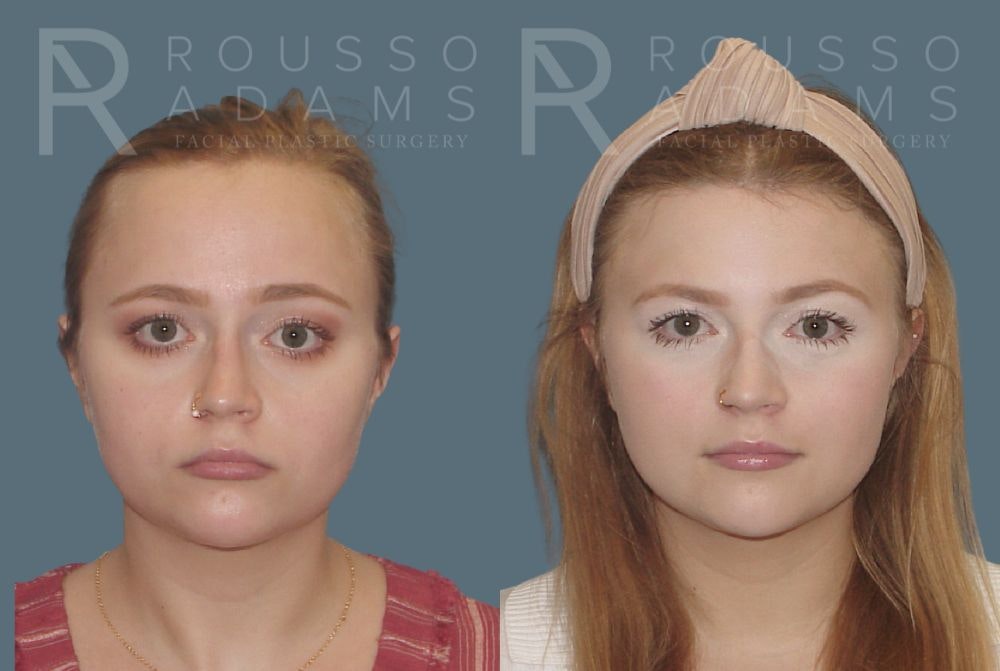 Hairline Advancement Before & After Gallery - Patient 190932 - Image 1