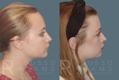Hairline Advancement Before & After Gallery - Patient 190932 - Image 2