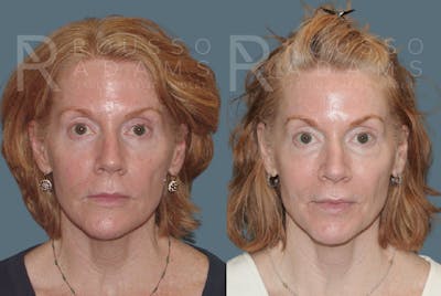 Skin Rejuvenation <span class=small>By Dr. Daniel Rousso</span> Before & After Gallery - Patient 147105368 - Image 1