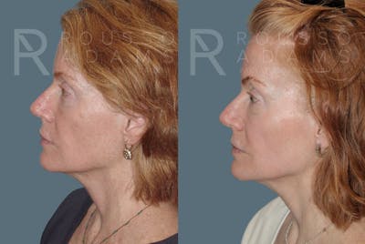Skin Rejuvenation <span class=small>By Dr. Daniel Rousso</span> Before & After Gallery - Patient 147105368 - Image 2