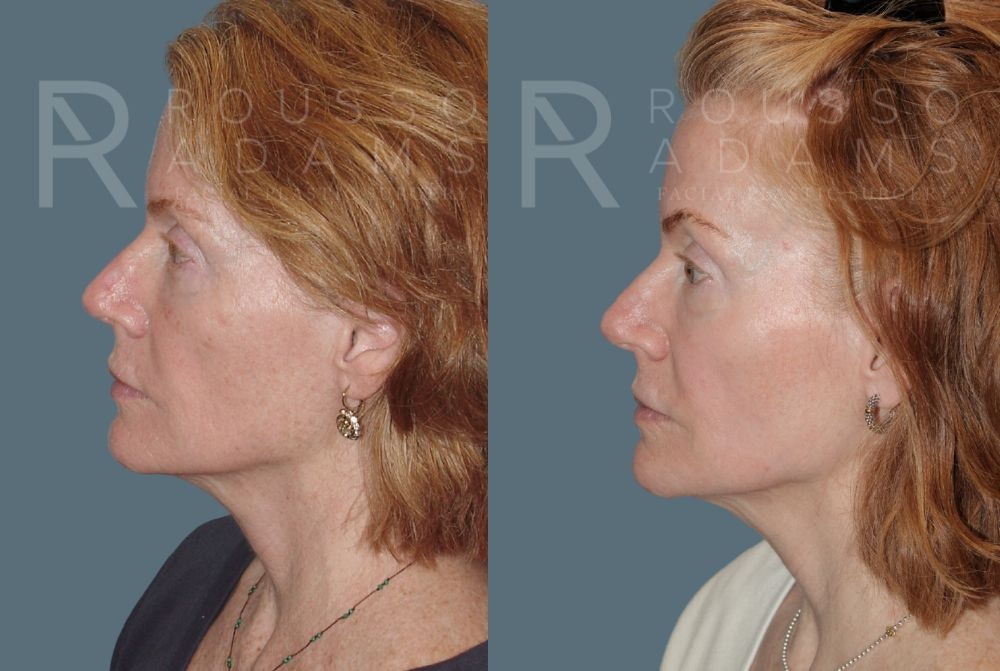 Skin Rejuvenation <span class=small>By Dr. Daniel Rousso</span> Before & After Gallery - Patient 147105368 - Image 2