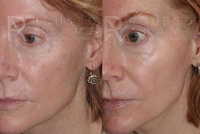 Skin Rejuvenation Before & After Gallery - Patient 147124271 - Image 1