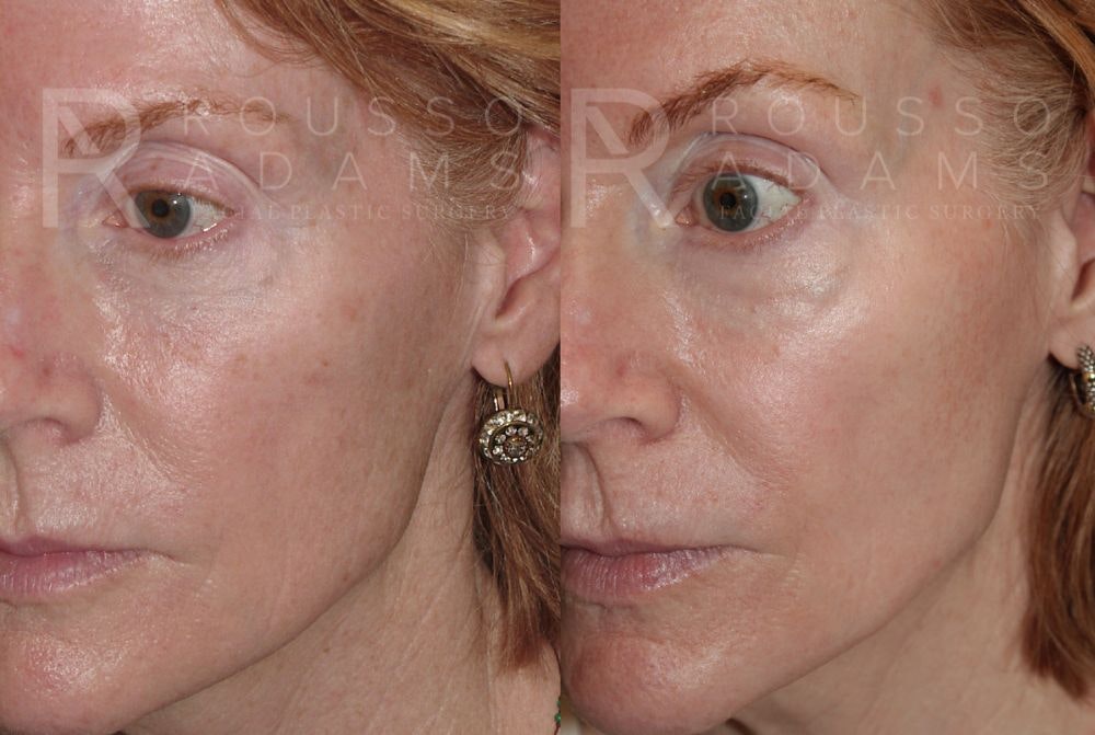 Skin Rejuvenation Before & After Gallery - Patient 147105368 - Image 3