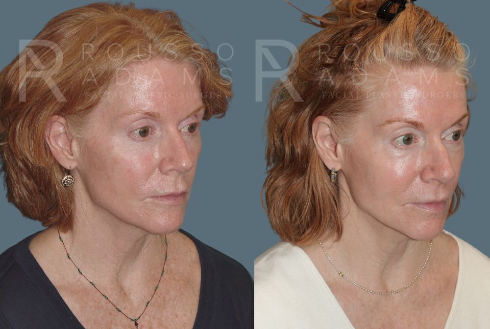 Skin Rejuvenation Before & After Gallery - Patient 147105368 - Image 4