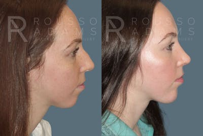 Rhinoplasty Before & After Gallery - Patient 147105369 - Image 1