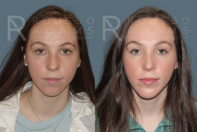 Rhinoplasty<span class=small>By Dr. Austin Adams</span> Before & After Gallery - Patient 148313248 - Image 2