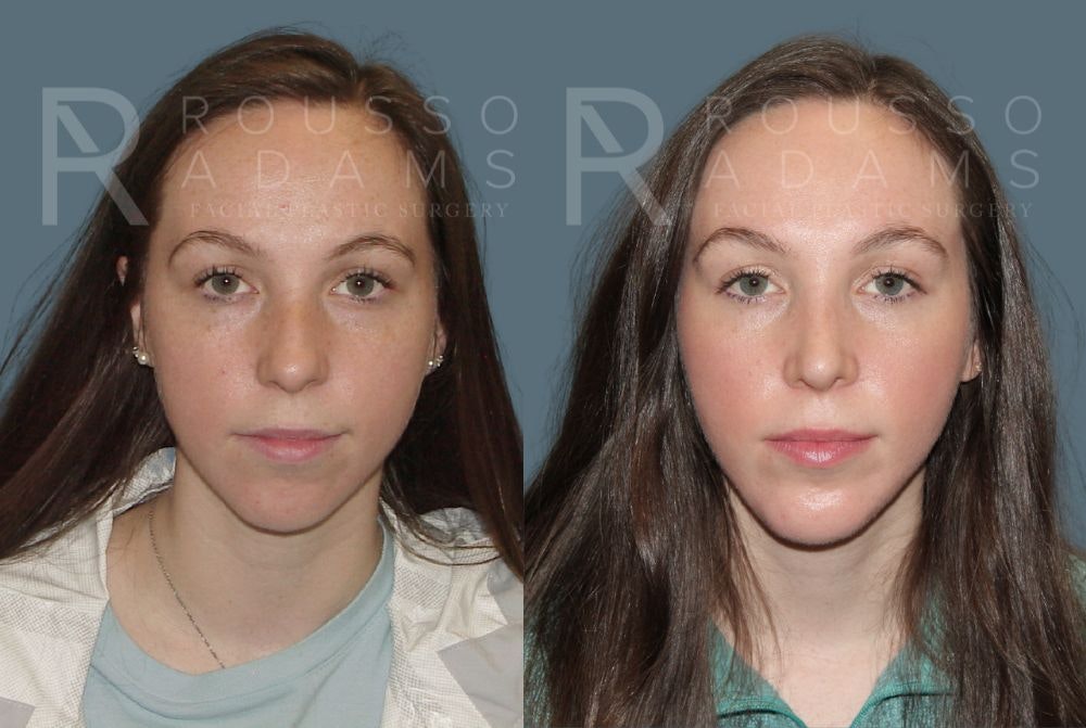 Rhinoplasty Before & After Gallery - Patient 147105369 - Image 2