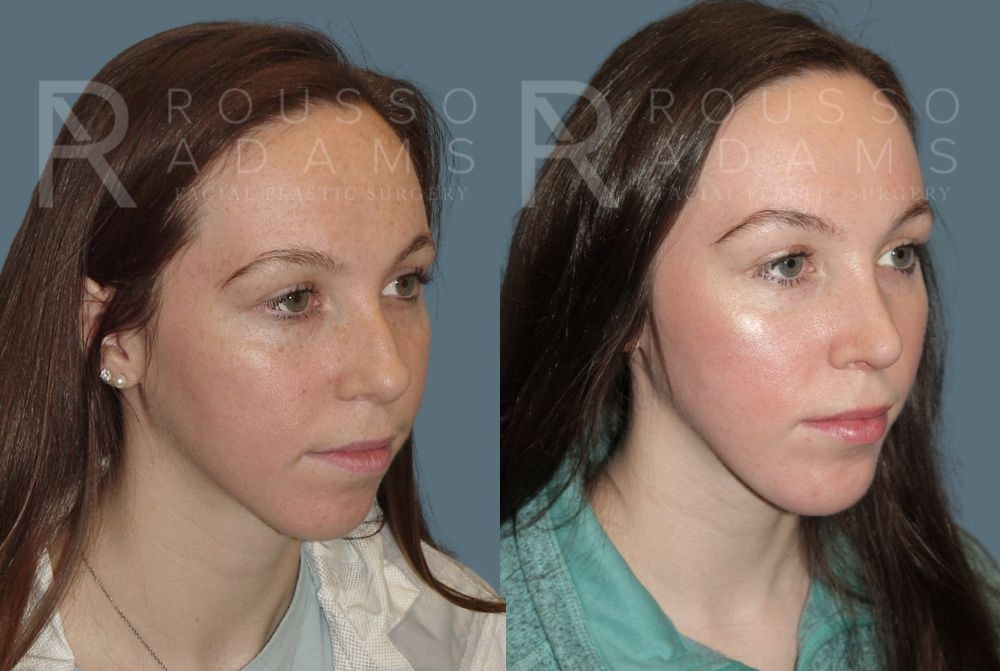 Rhinoplasty Before & After Gallery - Patient 148313248 - Image 3