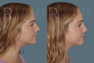 Liquid Rhinoplasty Before & After Gallery - Patient 147124313 - Image 1