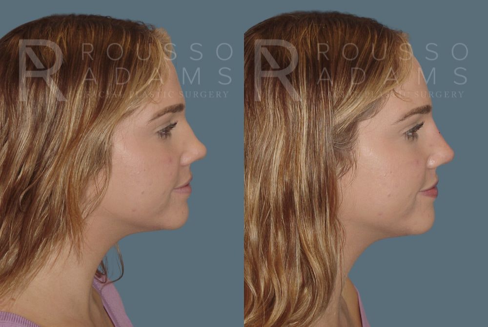 Liquid Rhinoplasty Before & After Gallery - Patient 147124313 - Image 1