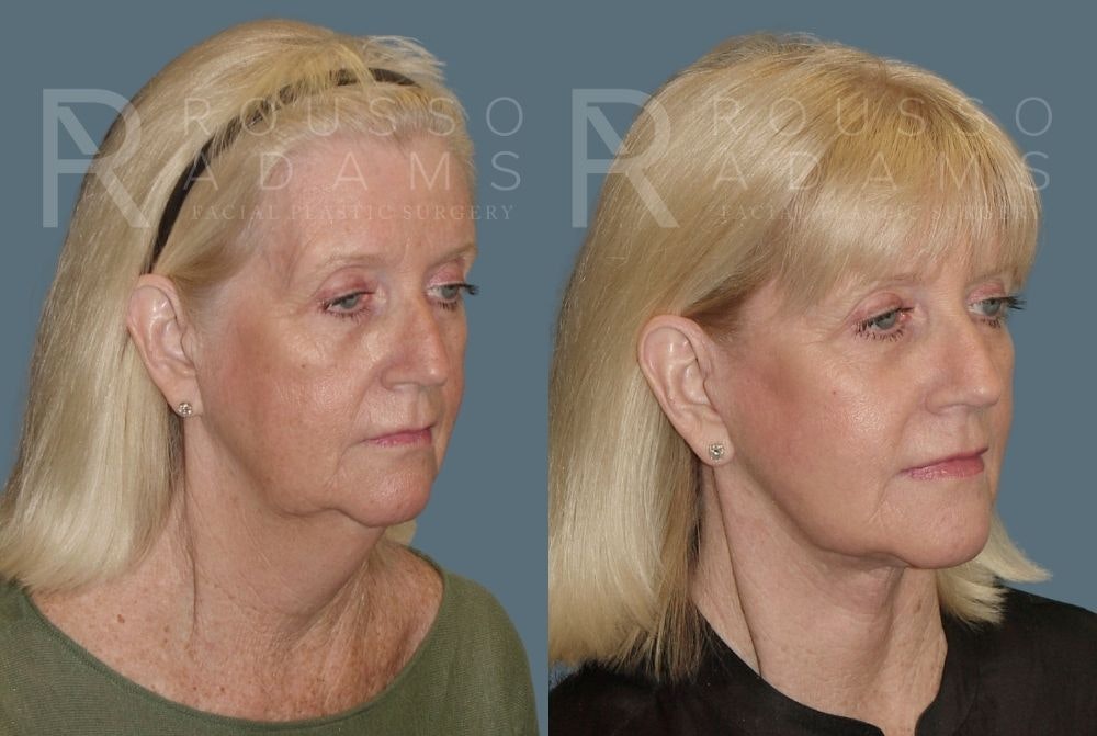 Facelift - Dr. Rousso Before & After Gallery - Patient 147374937 - Image 1