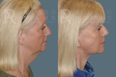 Facelift Before & After Gallery - Patient 147374937 - Image 2
