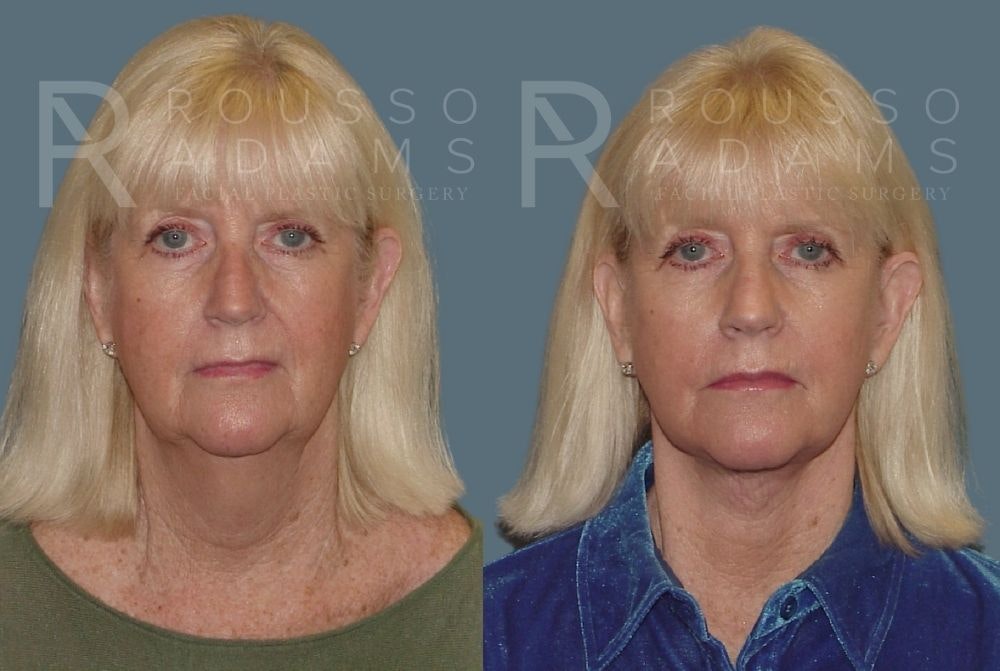 Facelift - Dr. Rousso Before & After Gallery - Patient 147374937 - Image 3