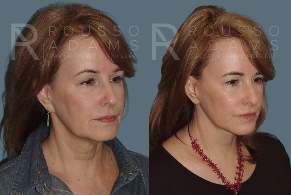 Facelift <span class=small>By Dr. Daniel Rousso</span> Before & After Gallery - Patient 147374982 - Image 1