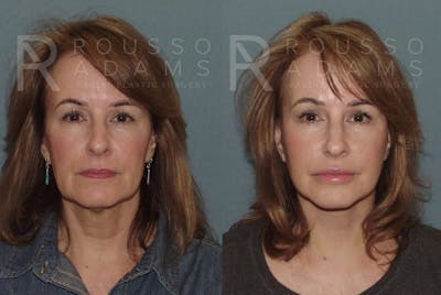 Facelift <span class=small>By Dr. Daniel Rousso</span> Before & After Gallery - Patient 147374982 - Image 2