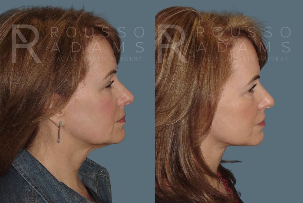 Facelift <span class=small>By Dr. Daniel Rousso</span> Before & After Gallery - Patient 147374982 - Image 3