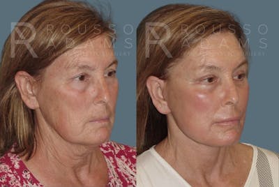 Facelift <span class=small>By Dr. Daniel Rousso</span> Before & After Gallery - Patient 147375000 - Image 1