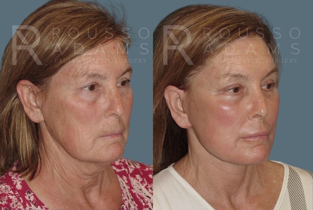 Facelift <span class=small>By Dr. Daniel Rousso</span> Before & After Gallery - Patient 147375000 - Image 1