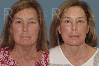 Facelift <span class=small>By Dr. Daniel Rousso</span> Before & After Gallery - Patient 147375000 - Image 2