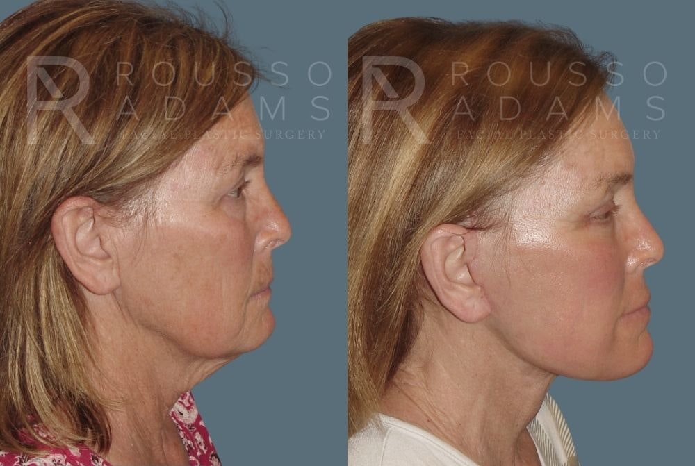 Facelift Before & After Gallery - Patient 147375000 - Image 3