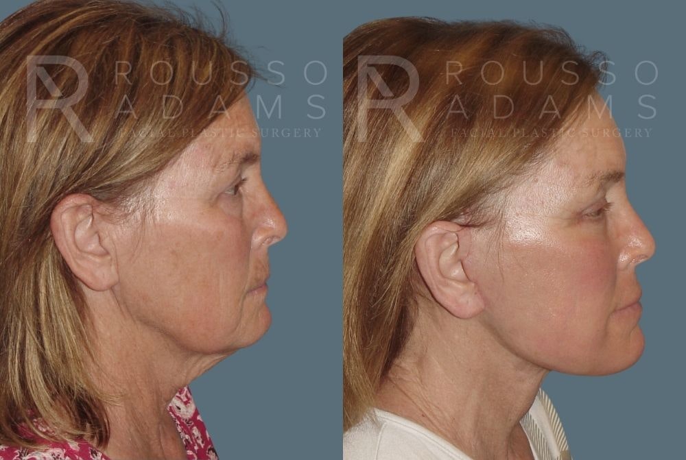 Facelift <span class=small>By Dr. Daniel Rousso</span> Before & After Gallery - Patient 147375000 - Image 3