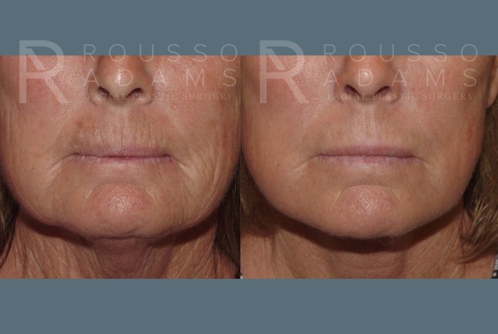 Facelift Before & After Gallery - Patient 147375000 - Image 4