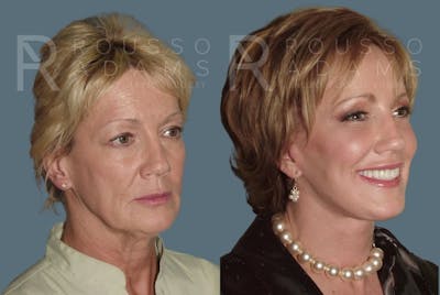 Facelift <span class=small>By Dr. Daniel Rousso</span> Before & After Gallery - Patient 147375003 - Image 1