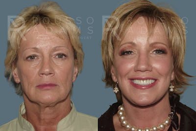 Facelift <span class=small>By Dr. Daniel Rousso</span> Before & After Gallery - Patient 147375003 - Image 2