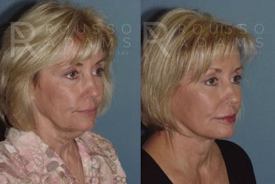 Facelift - Dr. Rousso Before & After Gallery - Patient 147375026 - Image 1