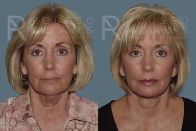 Facelift <span class=small>By Dr. Daniel Rousso</span> Before & After Gallery - Patient 147375026 - Image 2