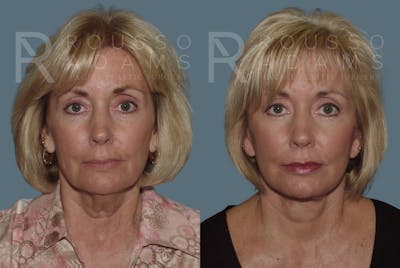 Facelift - Dr. Rousso Before & After Gallery - Patient 147375026 - Image 2