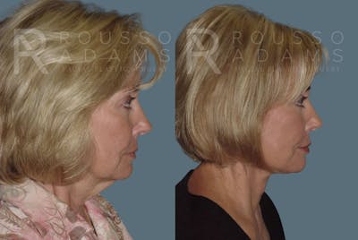 Facelift <span class=small>By Dr. Daniel Rousso</span> Before & After Gallery - Patient 147375026 - Image 4