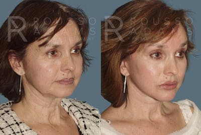 Facelift <span class=small>By Dr. Daniel Rousso</span> Before & After Gallery - Patient 147375030 - Image 1