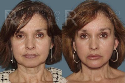 Facelift <span class=small>By Dr. Daniel Rousso</span> Before & After Gallery - Patient 147375030 - Image 2
