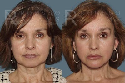 Facelift Before & After Gallery - Patient 147375030 - Image 2