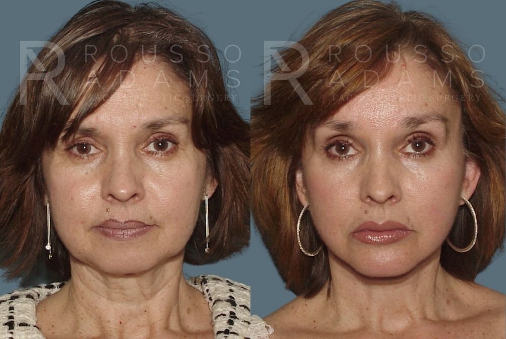 Facelift <span class=small>By Dr. Daniel Rousso</span> Before & After Gallery - Patient 147375030 - Image 2