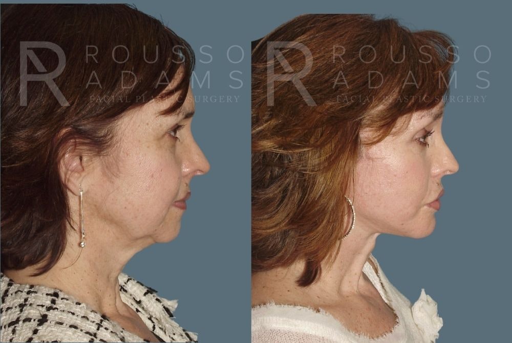 Facelift <span class=small>By Dr. Daniel Rousso</span> Before & After Gallery - Patient 147375030 - Image 3
