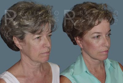 Facelift Before & After Gallery - Patient 147375031 - Image 1